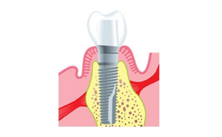 Dental Implants | all in four dentist in park ridge IL