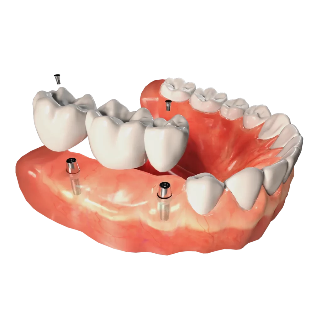 Dental Implants | Emergency Dental Des Plaines IL