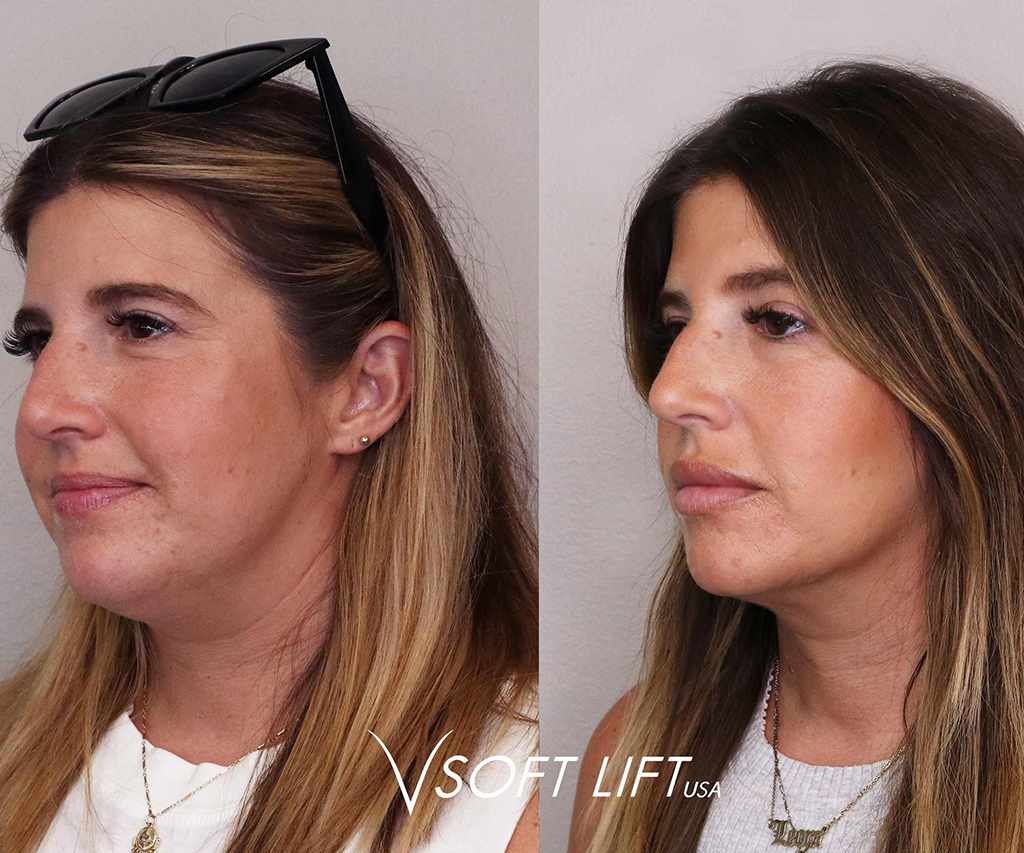 Before - Advanced Facial Aesthetic
