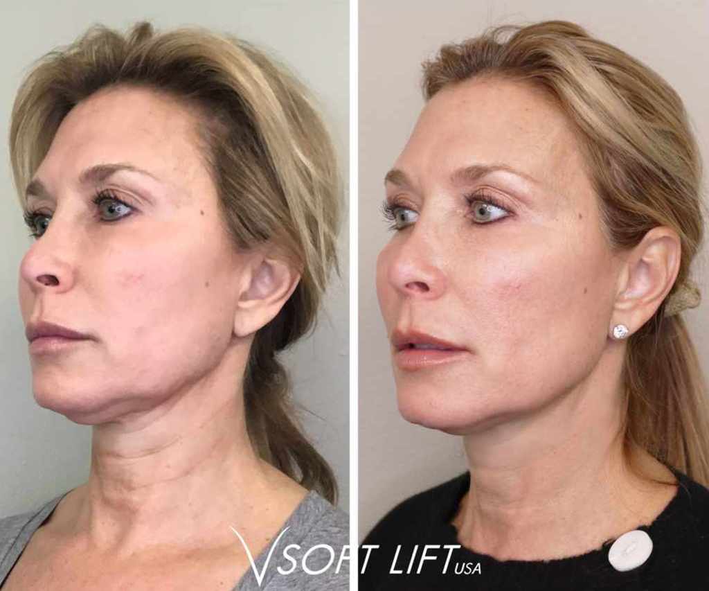 Before-After1-compressed