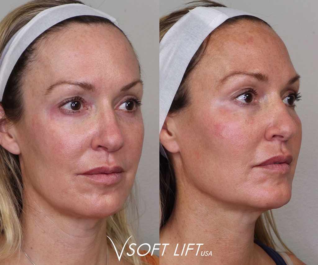 Before-After10-compressed