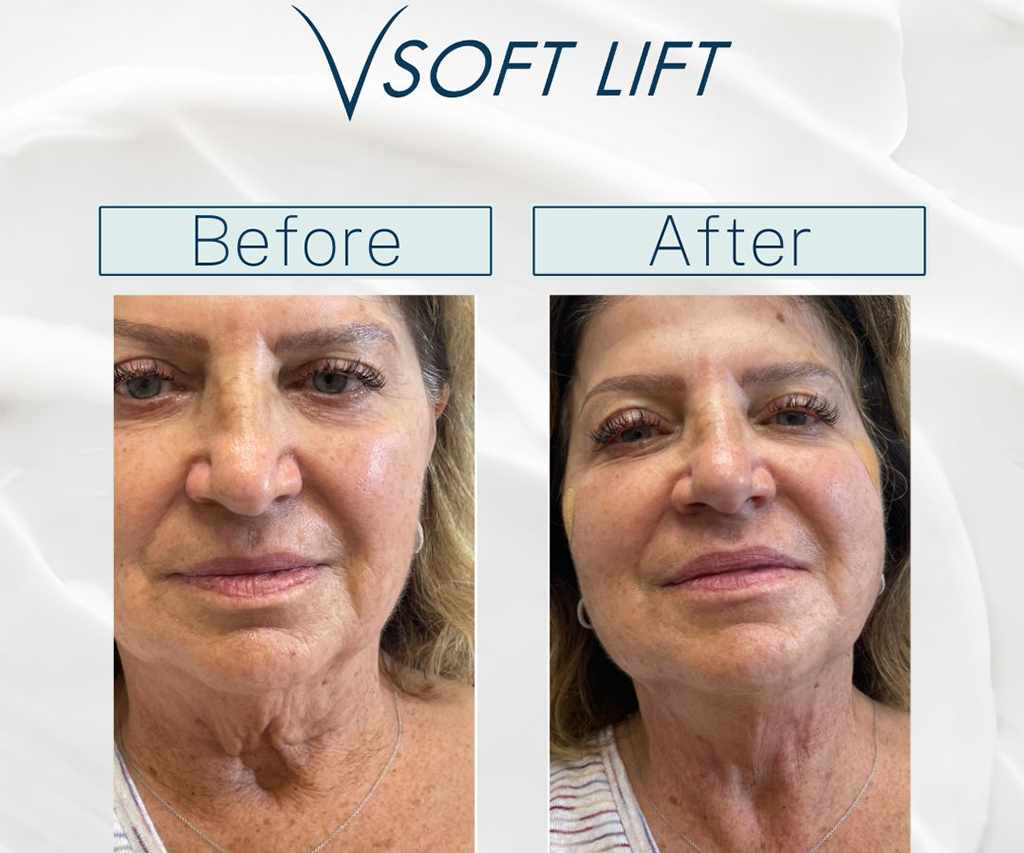 Before-After11-compressed