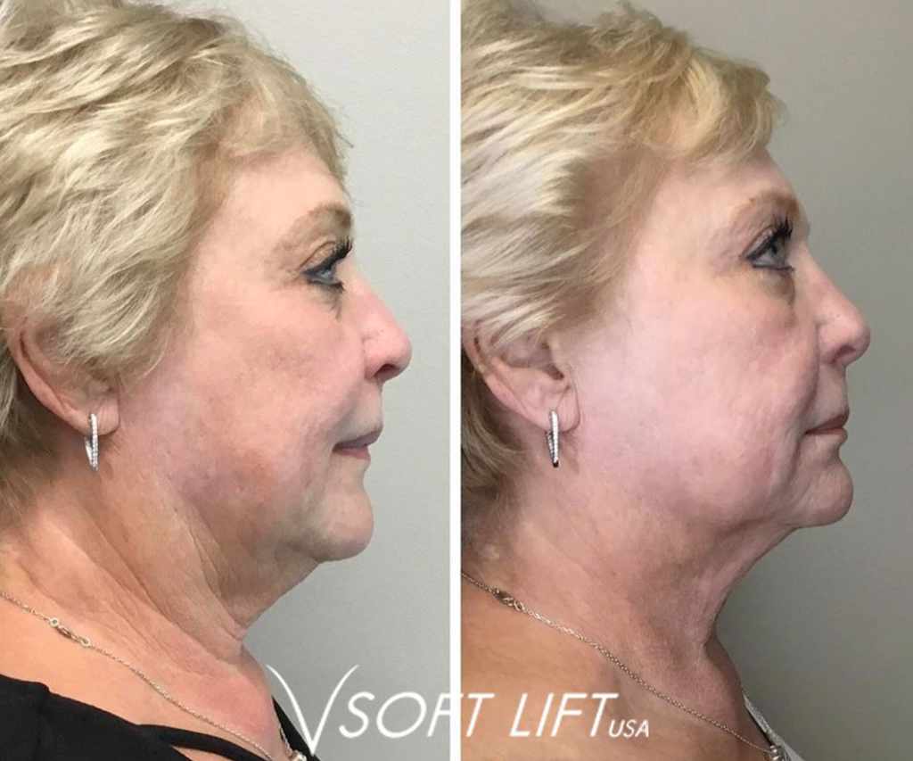 Before-After12-compressed