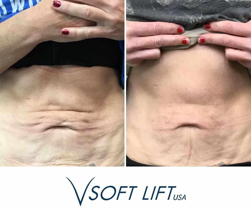 Before-After13-compressed