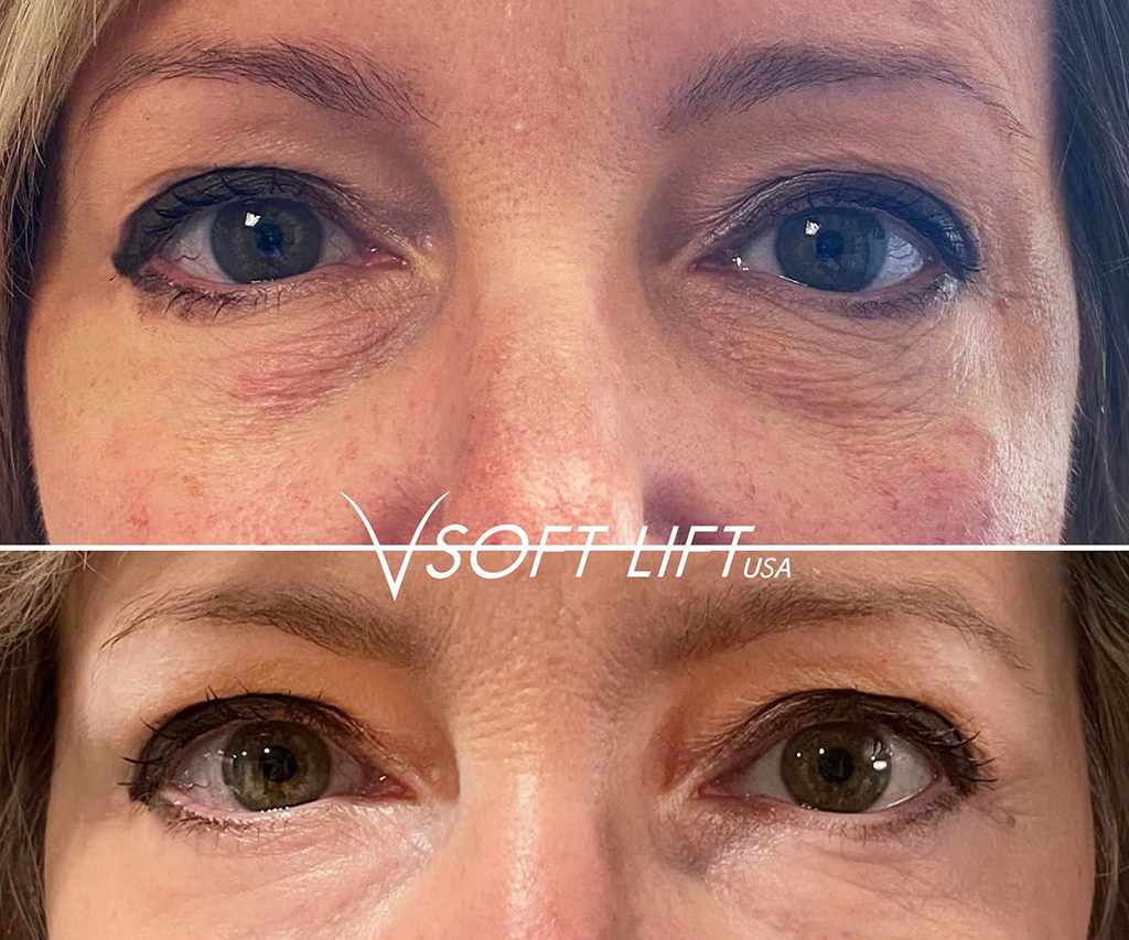 Before-After14-compressed