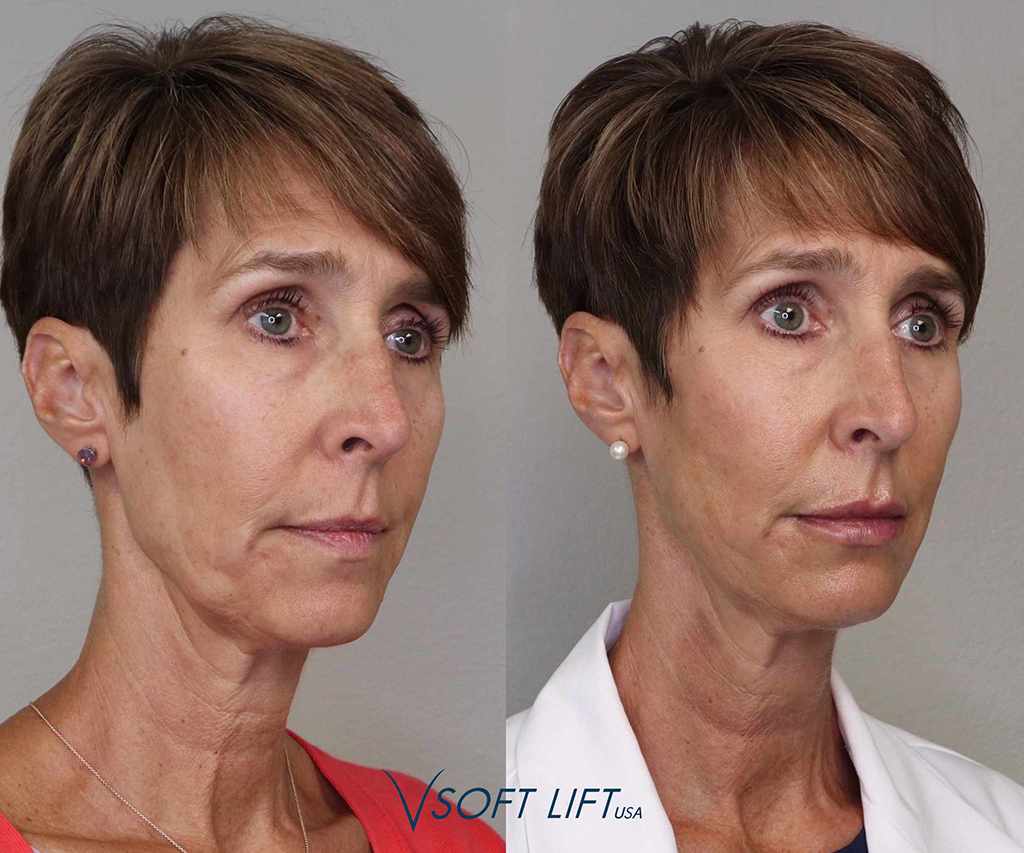 Before-After2-compressed