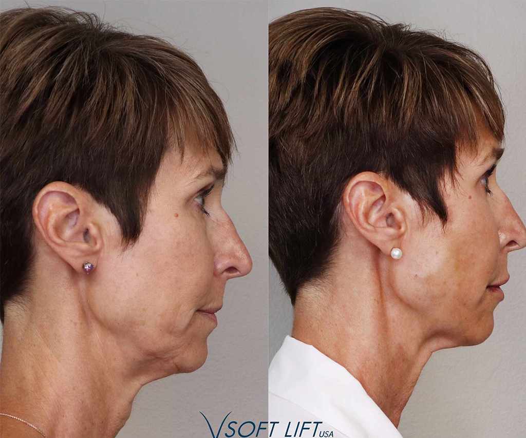 Before-After3-compressed