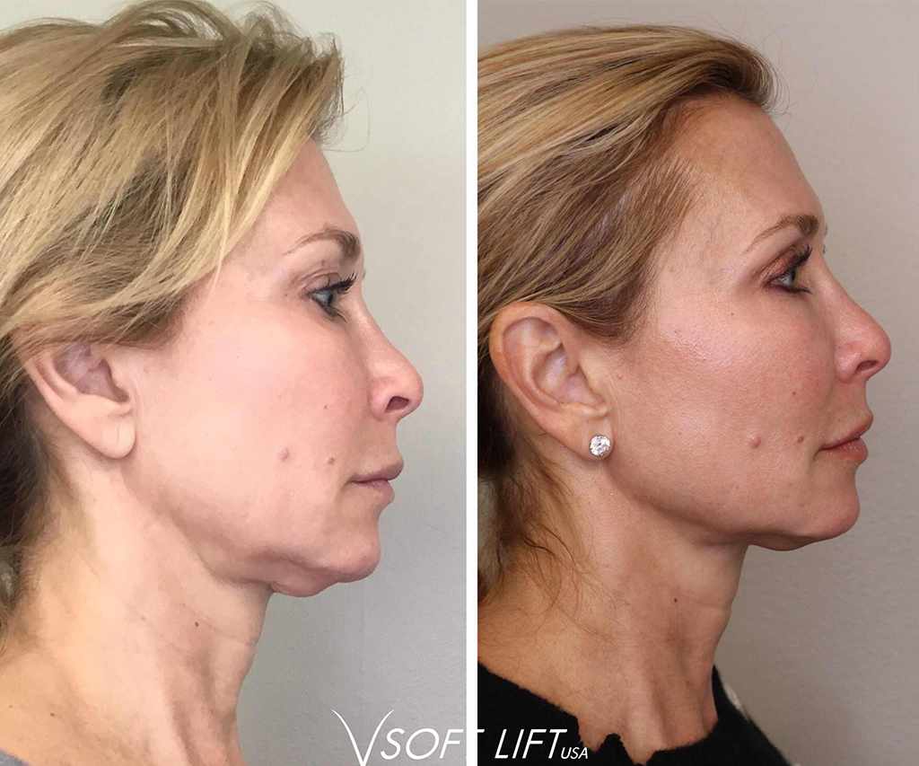 Before-After4-compressed