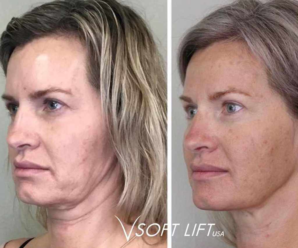 Before-After6-compressed