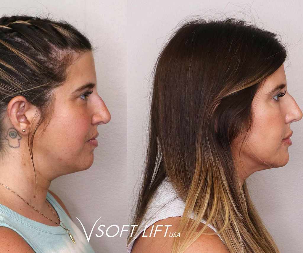 Before-After8-compressed