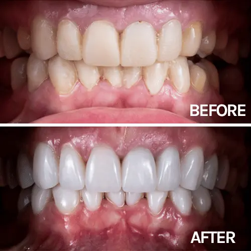 Cosmetic smile before after Park Ridge IL | Northshore Dental Group | Glenview