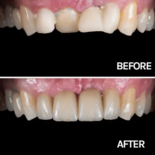 Before after same day tooth replacements | Northshore Dental Group | Norridge